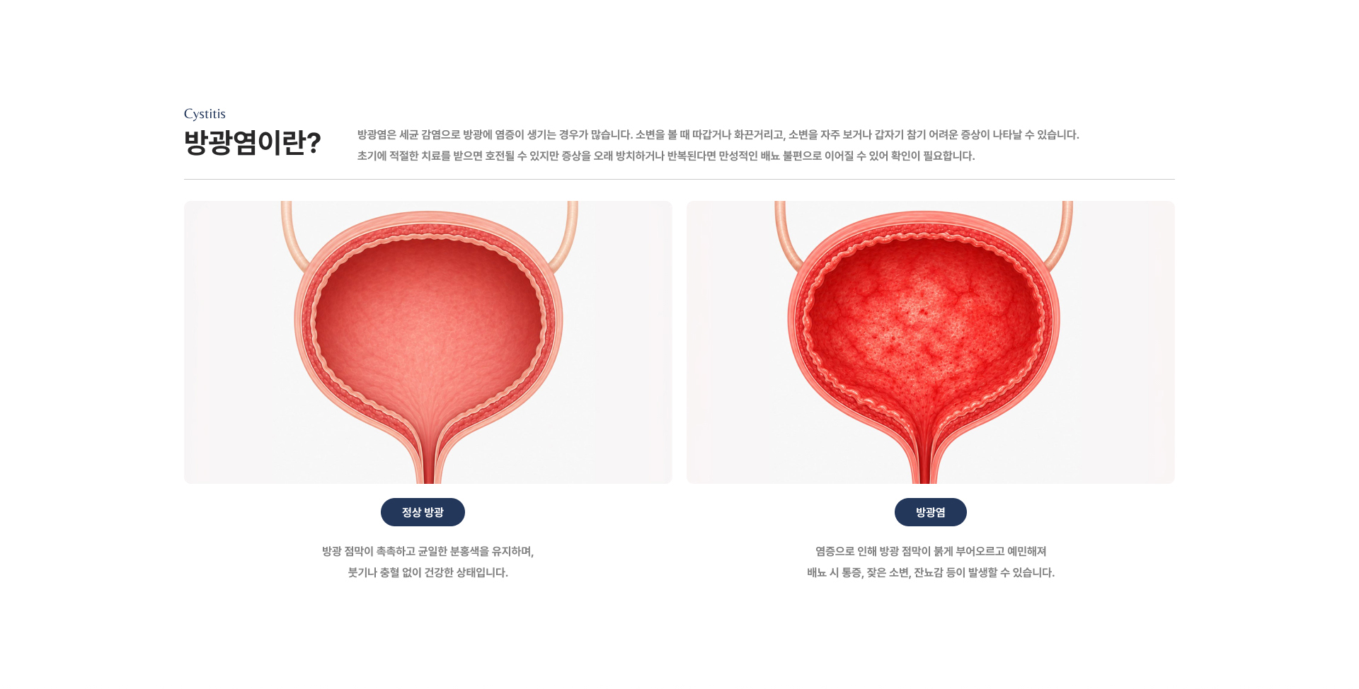 방광염