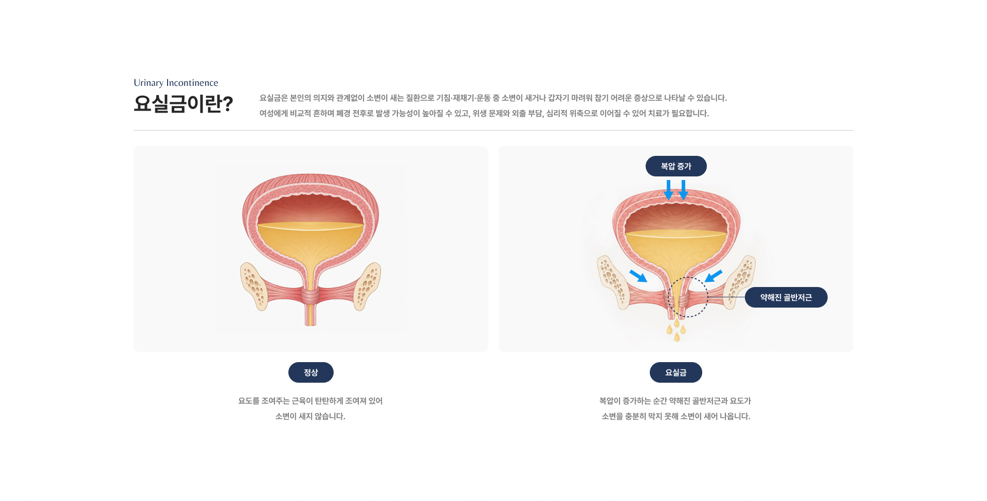 요실금