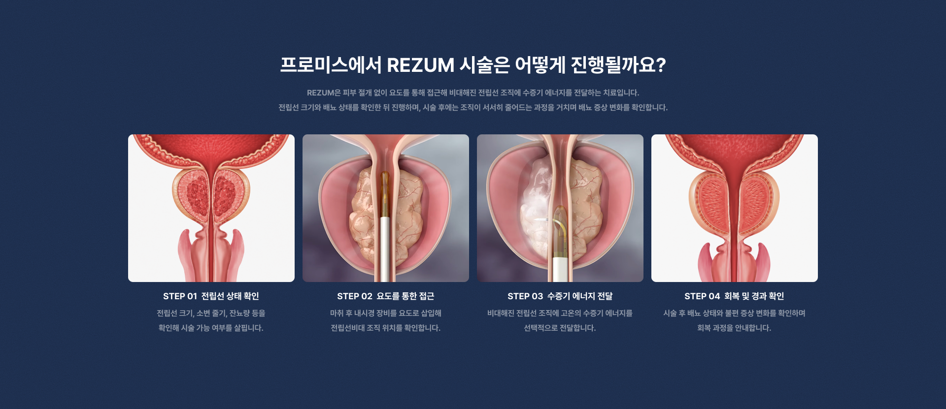 REZUM