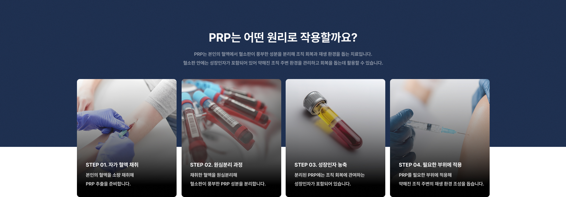 PRP 줄기세포