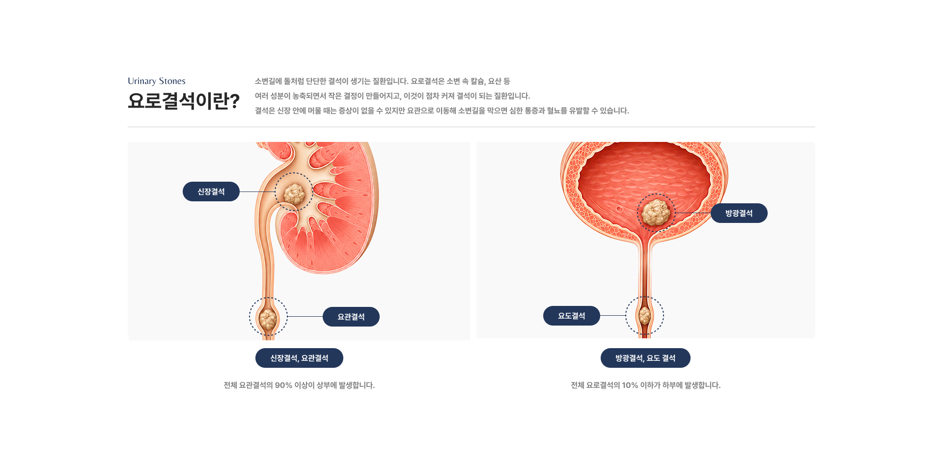 요로결석이란?